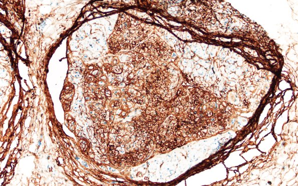 3D4 Half & Half Fascicle (Case 3) GLUT1 20X