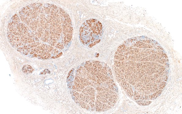 3E1 Half & Half Fascicle (Case 3) S100 4X