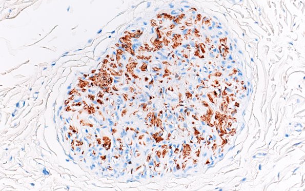 3E5 Perineurioma (Case 3) S100 40X 3.jpg