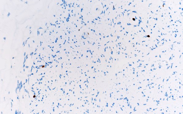 3F Perineurioma (Case 3) Ki67 40X 1.jpg