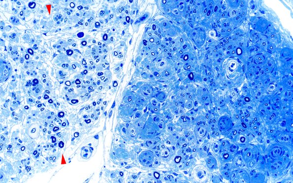 3G3 Half & Half Fascicle (Case 3) EMA 40X copy