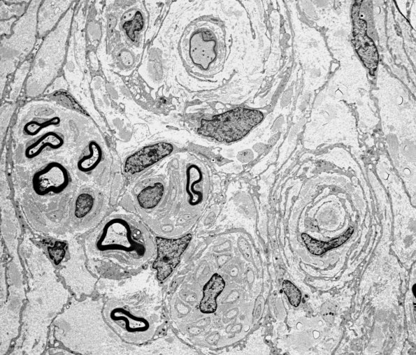 3H1 Perineurioma (Case 3) Tumor_008AB - Copy