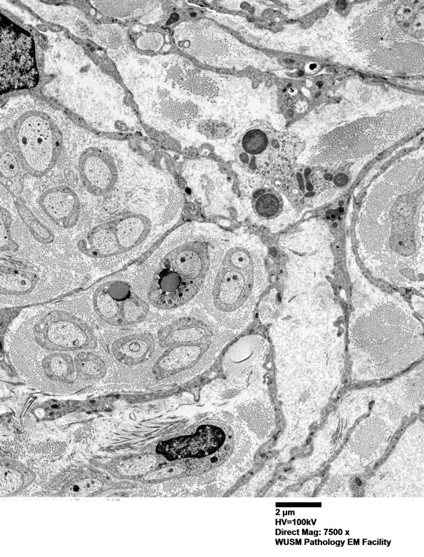 3H3 Perineurioma (Case 3) Tumor_018 - Copy