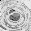 3H4 Perineurioma (Case 3) Tumor_037 - Copy