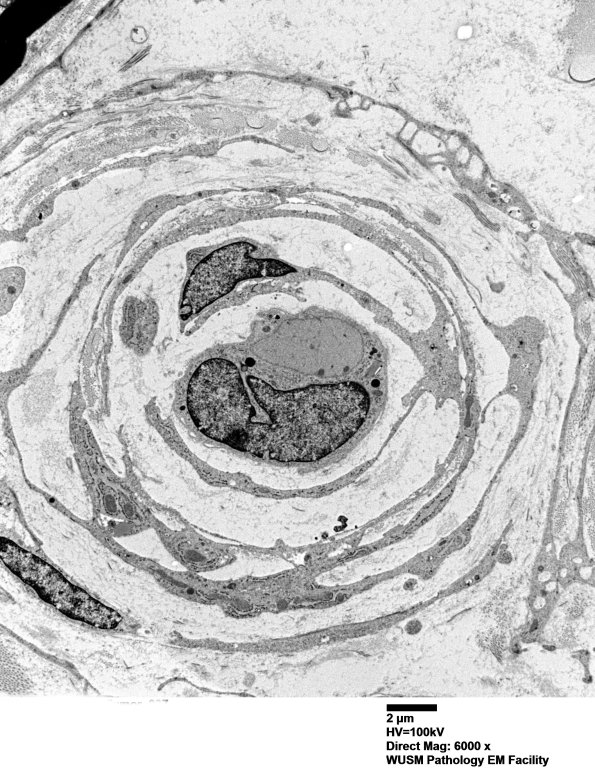 3H4 Perineurioma (Case 3) Tumor_037 - Copy