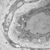 3H7 Perineurioma (Case 3) Tumor_021 - Copy