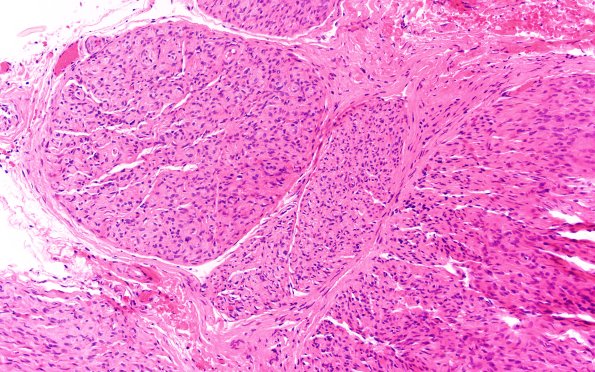 4A1 Perineurioma (Case 4) H&E 20X) 2