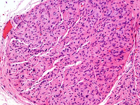 4A2 Perineurioma (Case 4) H&E 3.jpg