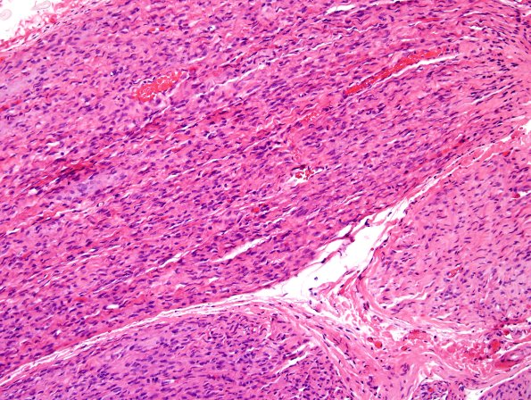 4A3 Perineurioma (Case 4) H&E 2.jpg