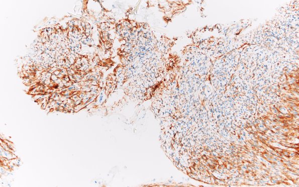 4B1 Perineurioma (Case 4) EMA 20X