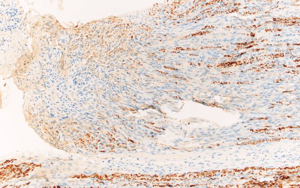 4C Perineurioma (Case 4) S100