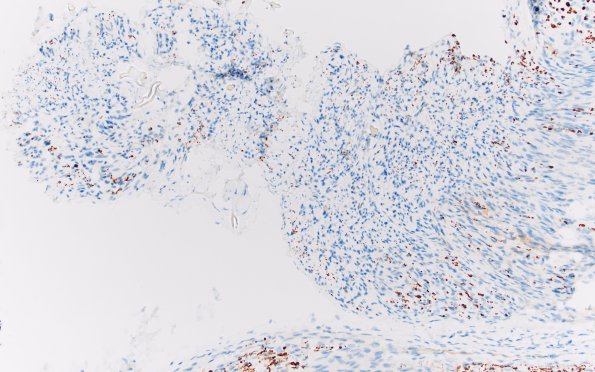 4D Perineurioma (Case 4) NF 20X 2