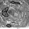 4F1 Perineurioma (Case 4) EM 003 - Copy