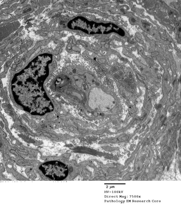 4F1 Perineurioma (Case 4) EM 003 - Copy