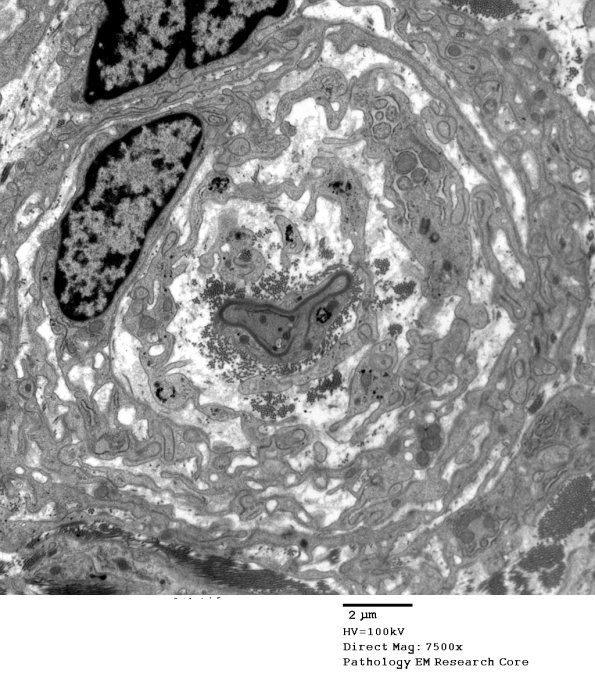 4F10 Perineurioma (Case 4) EM 041 - Copy