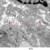 4F2 Perineurioma (Case 4) EM 005 copy - Copy