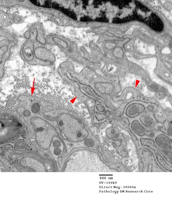 4F2 Perineurioma (Case 4) EM 005 copy - Copy