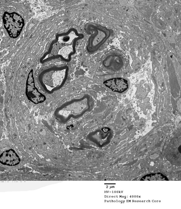 4F3 Perineurioma (Case 4) EM 047 - Copy