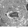 4F4 Perineurioma (Case 4 EM 009 - Copy