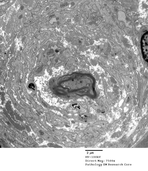 4F4 Perineurioma (Case 4 EM 009 - Copy