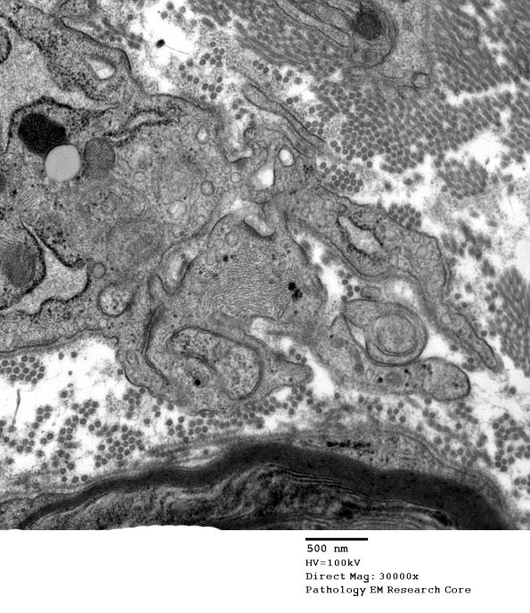 4F5 Perineurioma (Case 4) EM 014 - Copy