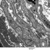 4F6 Perineurioma (Case 4) EM 015 - Copy