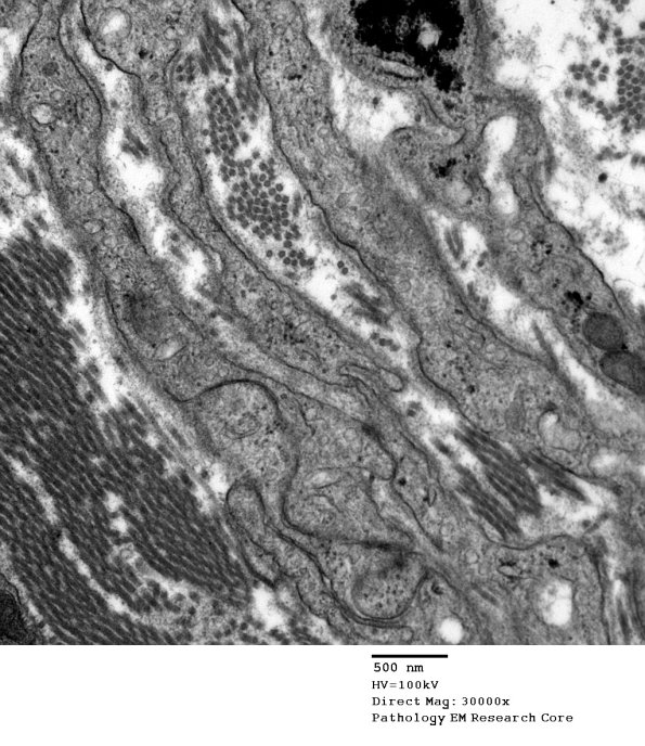 4F6 Perineurioma (Case 4) EM 015 - Copy