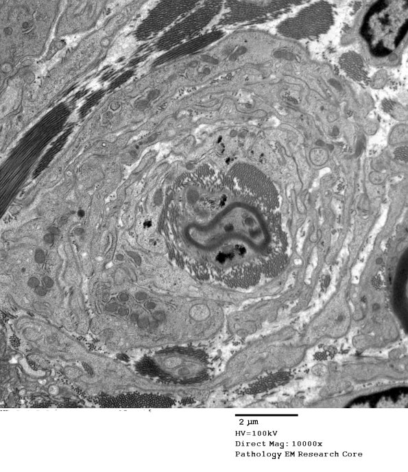 4F7 Perineurioma (Case 4) EM 053 - Copy