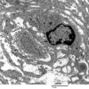 4F8 Perineurioma (Case 4) EM 032 - Copy