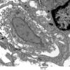 4F9 Perineurioma (Case 4) EM 034 - Copy