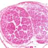 5A1 Perineurioma (Case 5) H&E 4X 2