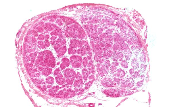 5A1 Perineurioma (Case 5) H&E 4X 2