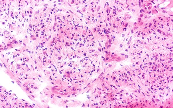 5A3 Perineurioma (Case 5) h&e 40X