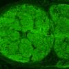 5B1 Perineurioma (Case 5) Pestronk EMA 2