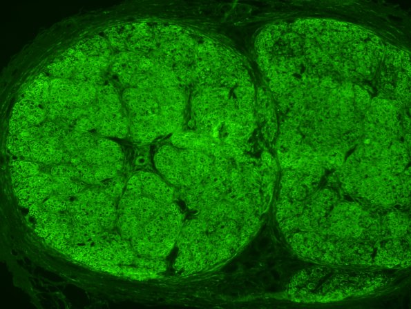 5B1 Perineurioma (Case 5) Pestronk EMA 2