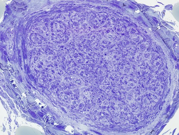 5C1 Perineurioma (Case 5) Plastic 4.jpg