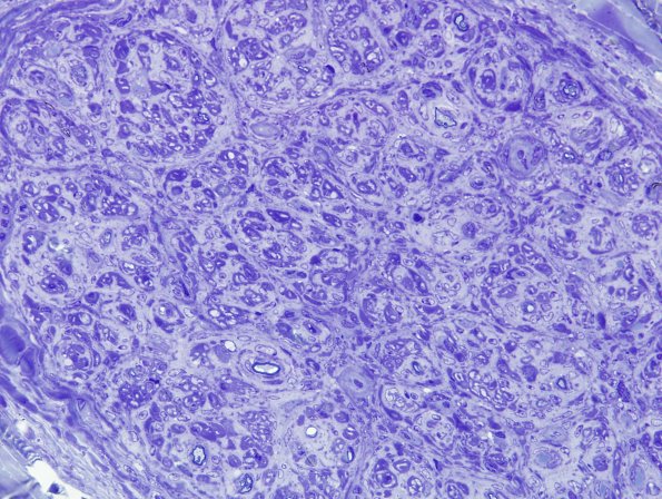 5C2 Perineurioma (Case 5) Plastic 5.jpg