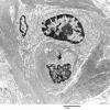 5D1 Perineurioma (Case 5) EM 011 - Copy