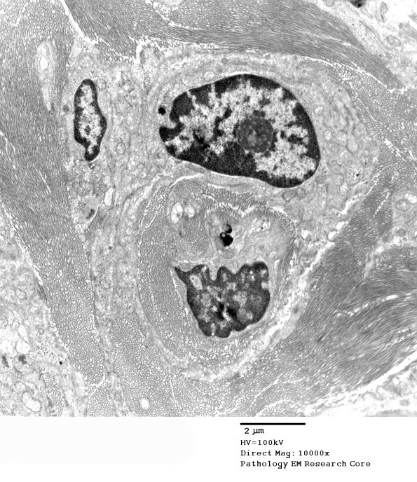 5D1 Perineurioma (Case 5) EM 011 - Copy