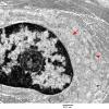 5D2 Perineurioma (Case 5) EM 012A copy - Copy