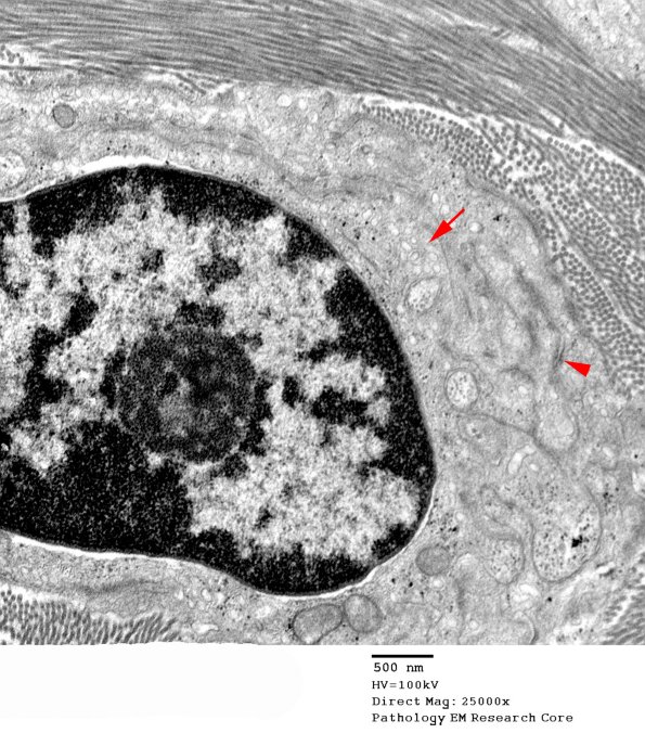 5D2 Perineurioma (Case 5) EM 012A copy - Copy