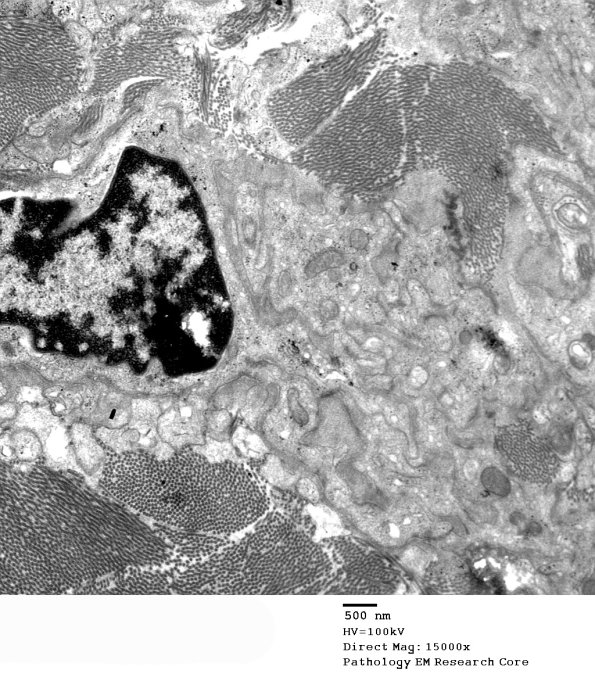 5D3 Perineurioma (Case 5) EM 018 - Copy