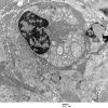 5D5 Perineurioma (Case 5) EM 070 - Copy