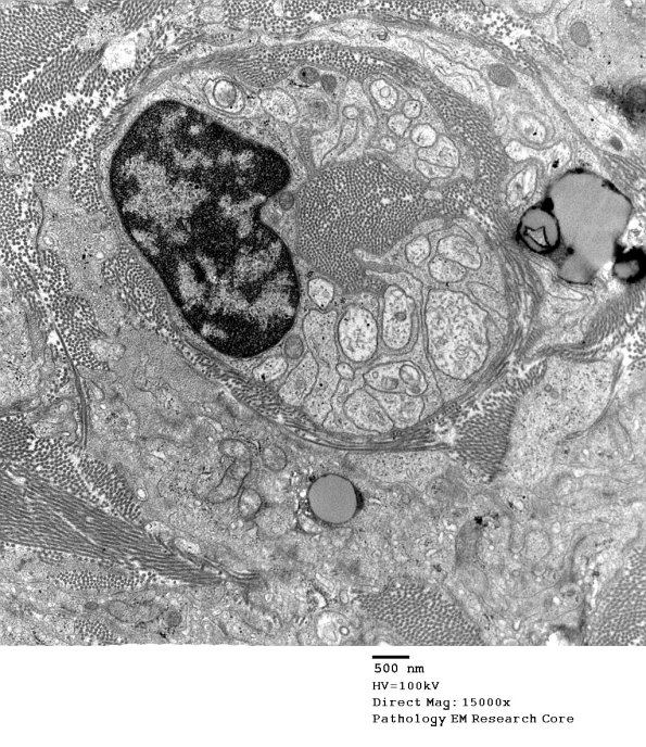 5D5 Perineurioma (Case 5) EM 070 - Copy