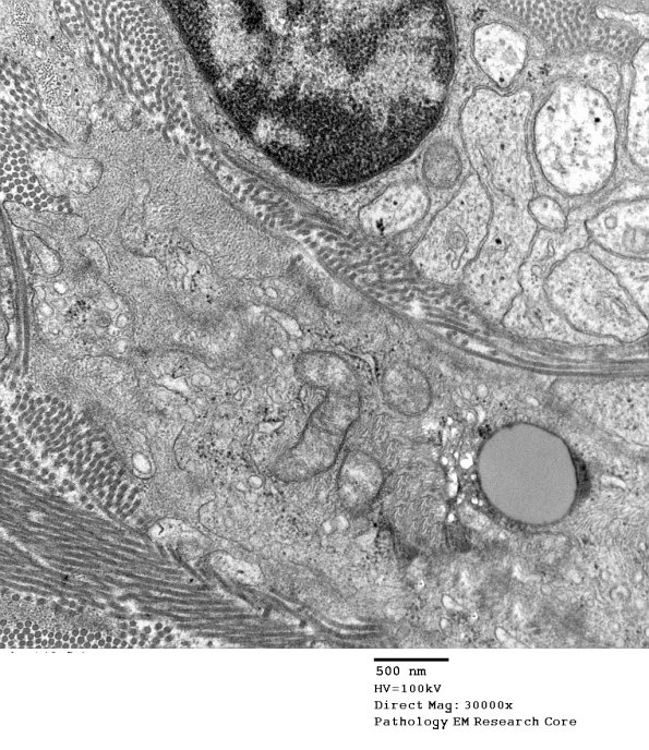 5D6 Perineurioma (Case 5) EM 071 - Copy