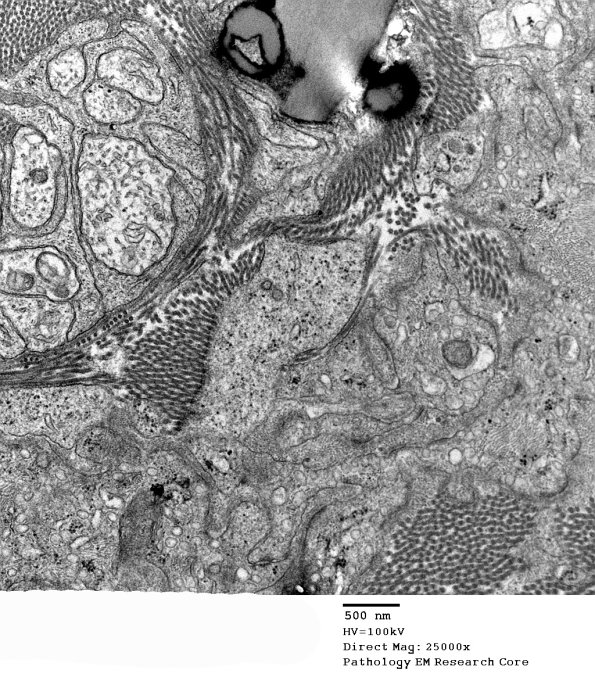 5D7 Perineurioma (Case 5) EM 073 - Copy