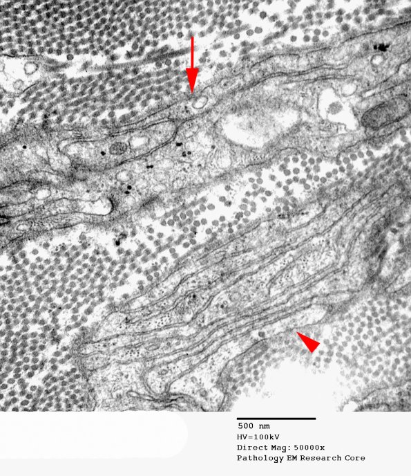 5D8 Perineurioma (Case 5) EM 109 copy - Copy