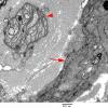 5D9 Perineurioma (Case 5) EM 125A copy - Copy