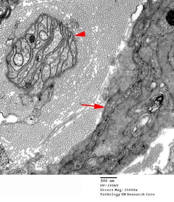 5D9 Perineurioma (Case 5) EM 125A copy - Copy