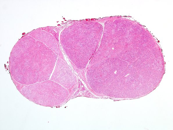 6A1 Perineurioma (Case 6) H&E 5